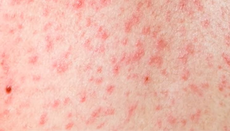 ठेउला सङ्क्रमणबाट बालबालिका प्रभावित