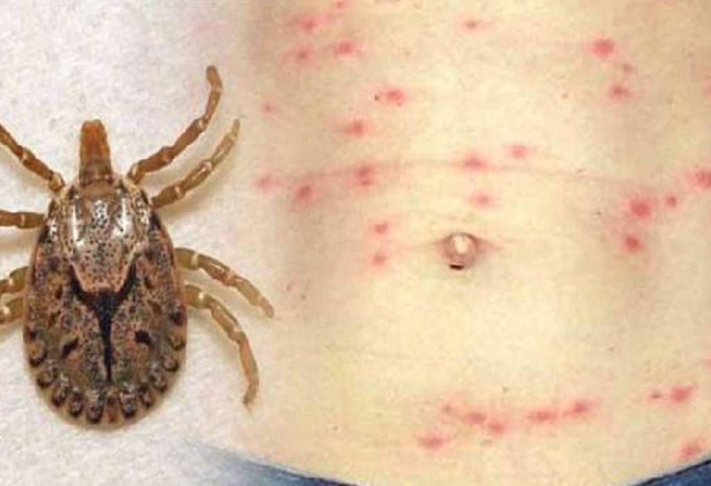 ‘स्क्रब टाइफस’बाट एक जनाको मृत्यु